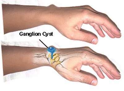 Ganglion Cyst Wrist Surgery