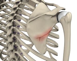 Fracture of the Shoulder Blade | Advanced Orthopaedics & Sports ...