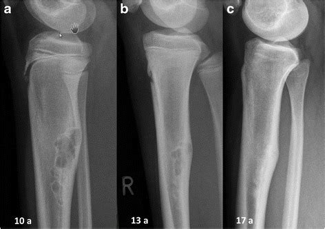 Bone tumor - Wikiwand