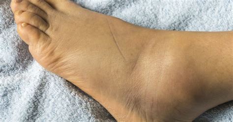 Swollen feet: 15 causes, treatments, and home remedies