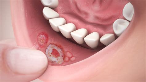 Aphthous Ulcers Shown and Explained Using Medical Animation Still Shot