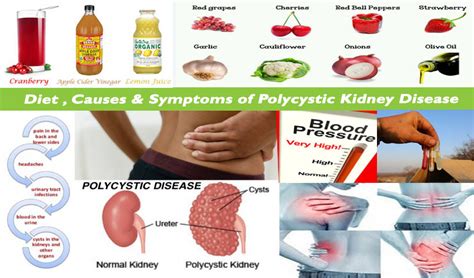 Natural Health And Beauty Tips: Get Best Polycystic Kidney Disease ...