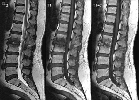 Mri Images Spine