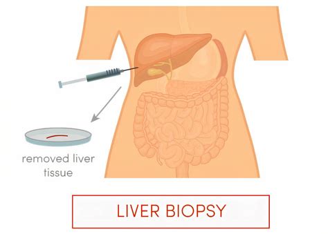 Liver Biopsy; Indications, Contraindications, Preparing and Procedure