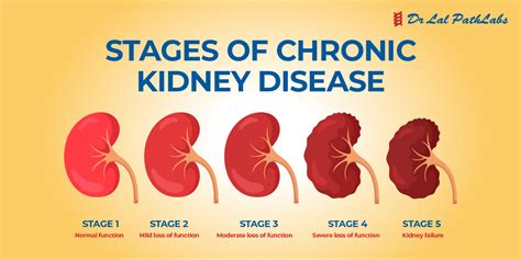 Kidney Disease: Types, Symptoms & Diagnosis - Dr Lal PathLabs Blog