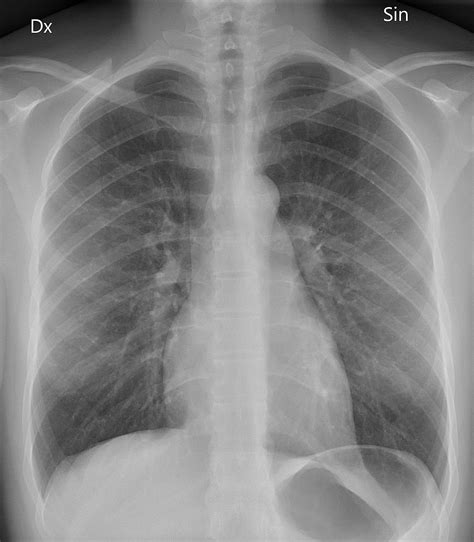 Chest radiograph - Wikipedia