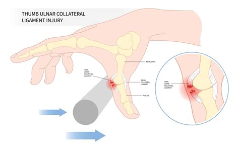 The Metacarpophalangeal Joint - Ligaments - TeachMeAnatomy