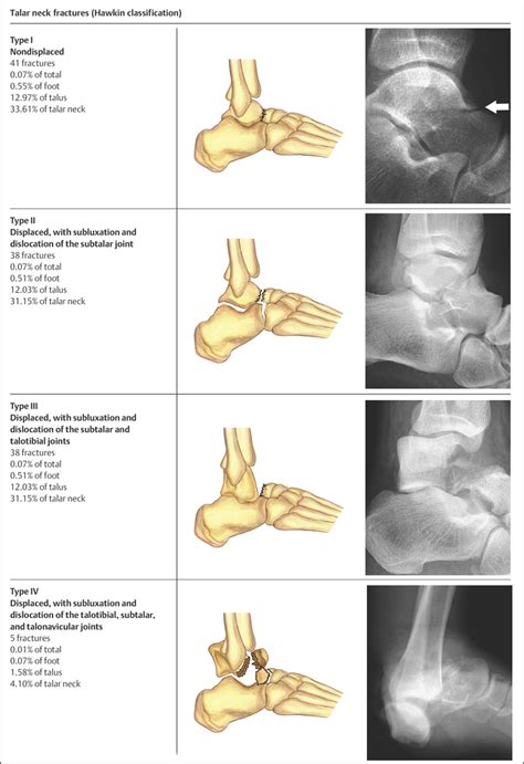 Foot Fractures | Musculoskeletal Key