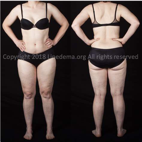 Staging of Lipedema — Lipedema Foundation