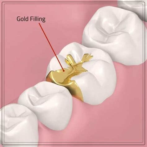 Gold Fillings: Pros and Cons - Engiomed