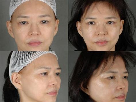 Eyelid Surgery Brow Lift A162 | Summit Health