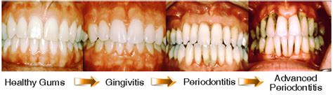 Gingivitis ~ Causes, Symptoms And Prevention ~ Abeyek