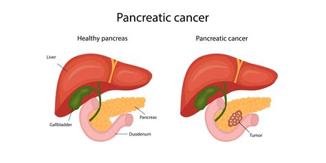 Pancreatic Cancer: What Is It, Symptoms, Causes & Treatment