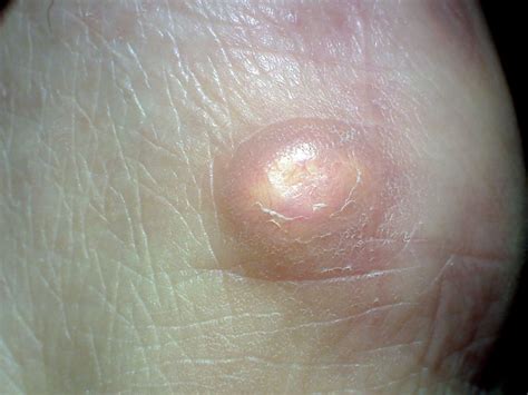 Boil vs. Cyst: How to Identify Them