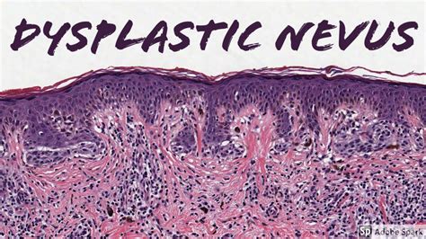 Junctional Nevus Histology