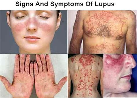 Lupus - Systemic Lupus Erythematosus (SLE) - Causes, Sign & Symptoms