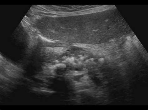 Abdomen and retroperitoneum | 1.3 Pancreas : Case 1.3.7 Pancreas ...