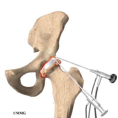 Hip Osteoarthritis | Houston Methodist