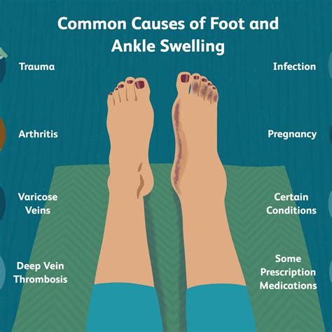 How To Keep Ankles From Swelling - Aimsnow7