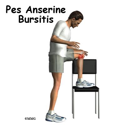 Pes Anserine Bursitis of the Knee - eOrthopod.com