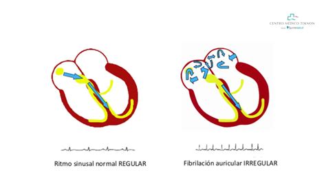 Fibrilación auricular: la arritmia cardiaca más frecuente y la que ...