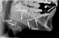 Sialogram - Imaging Glossary - Patients - UR Medicine Imaging Sciences ...