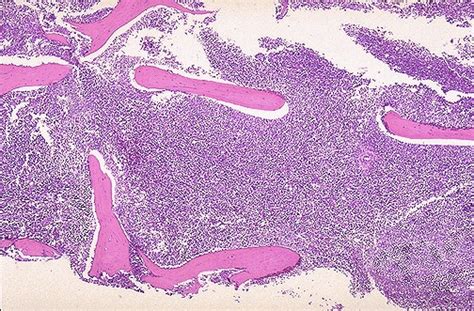 Leukemia - Pathology - Orthobullets