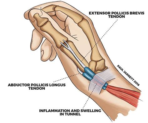 DeQuervain’s Tenosynovitis - Hand & Wrist Surgeon Perth