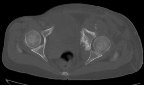 Pelvic Osteosarcoma-CT - Sumer's Radiology Blog