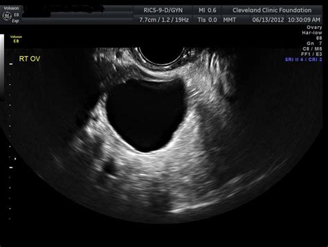 Ovarian Cysts