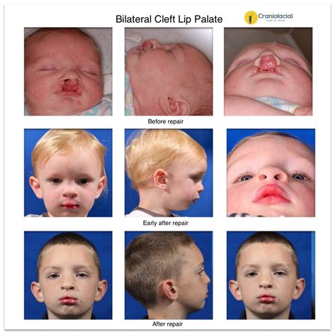 Picture Of A Cleft Palate