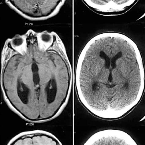 MRI and CT scans in patient 3. (A) Preoperative, TI-weighted, axial ...