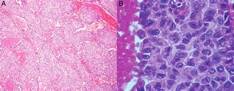 Pathology of the tumour. (A) Haematoxylin and eosin stain (H&E stain ...