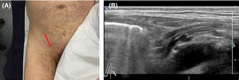 Evaluation of hernia of the male inguinal canal: sonographic method ...