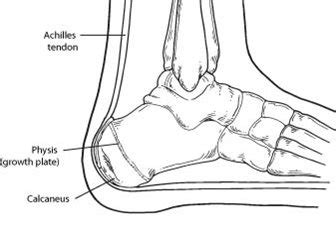 Calcaneal Apophysitis – California Foot and Ankle Institute