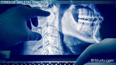 Skeletal Traction: Types & Complications - Video & Lesson Transcript ...