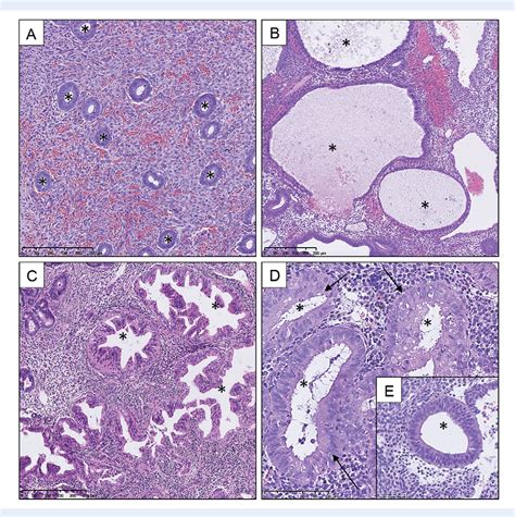 [PDF] New concepts for an old problem: the diagnosis of endometrial ...