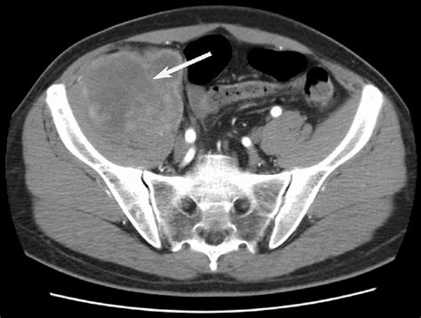 Pelvic Ct Scan