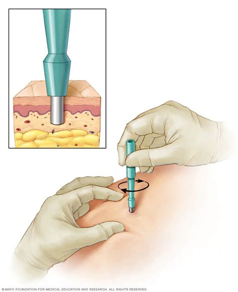 Skin Biopsy ~ Lab Tests Guide