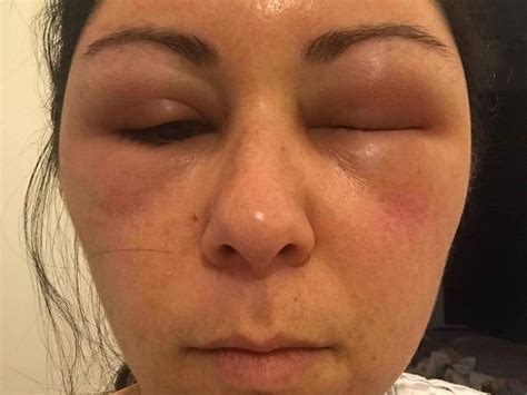 Woman’s head swells like a balloon after shocking allergic reaction to ...