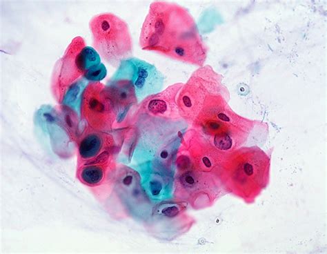 What Is An "Abnormal" Pap Smear?