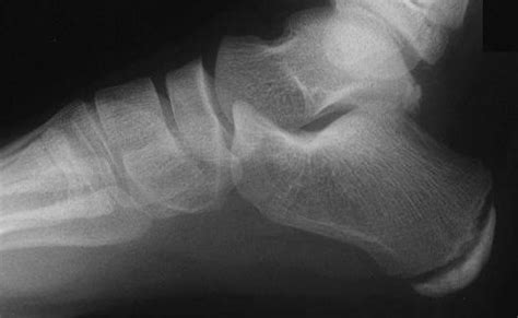 Severs Disease (Calcaneal Apophysitis) - Ankle, Foot and Orthotic Centre