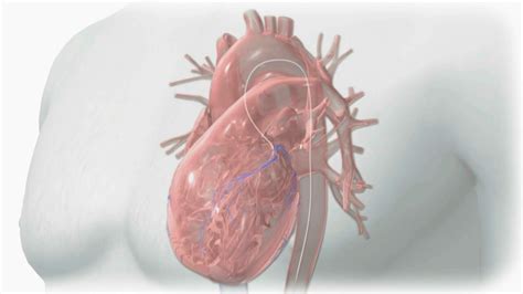 Heart Catheterization Dye Kidney