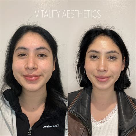 What to expect from jaw Botox! | Vitality Aesthetics