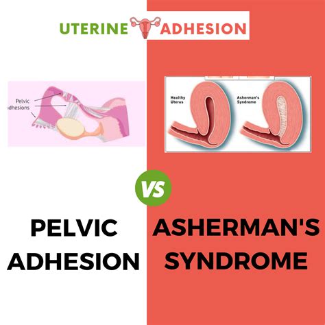 Pelvic Adhesions Vs Asherman's Syndrome - Uterine Adhesion