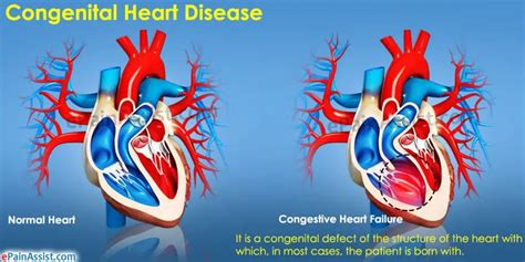 Hereditary Heart Disease Causes, Types, and Treatment