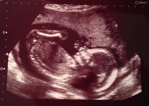 How to Make a Smile: Baby Girl - 20 week ultrasound