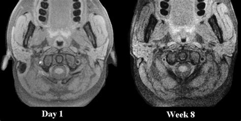 Vertebral Artery Dissection Mri