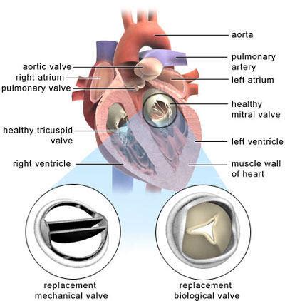 Mitral Valve Replacement Positioning Diagram