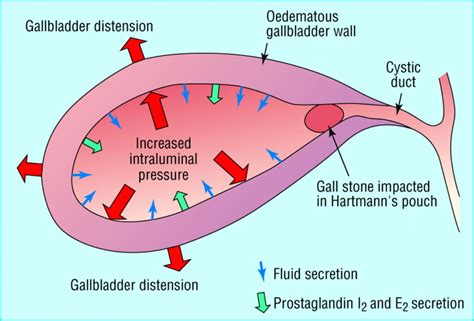 Acute cholecystitis | PaReflectionEd